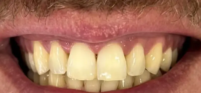Antes: dentes amarelados
