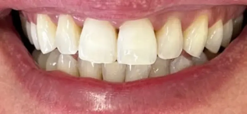 Depois: dentes mais claros e alinhados na cor