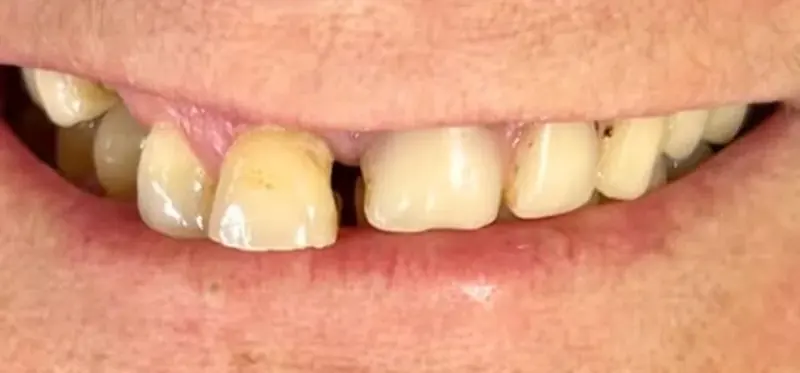 Antes: dentes escuros, desgastados e com espaço