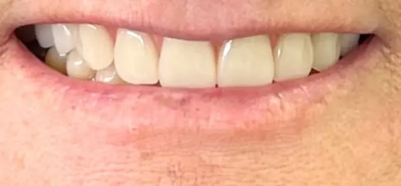 Depois: dentes com forma e cor uniformes
