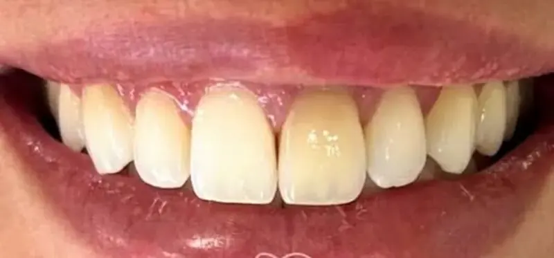 Antes: um dente da frente mais escuro
