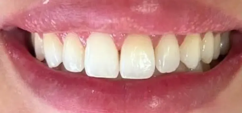 Depois: os dois dentes da frente na mesma cor
