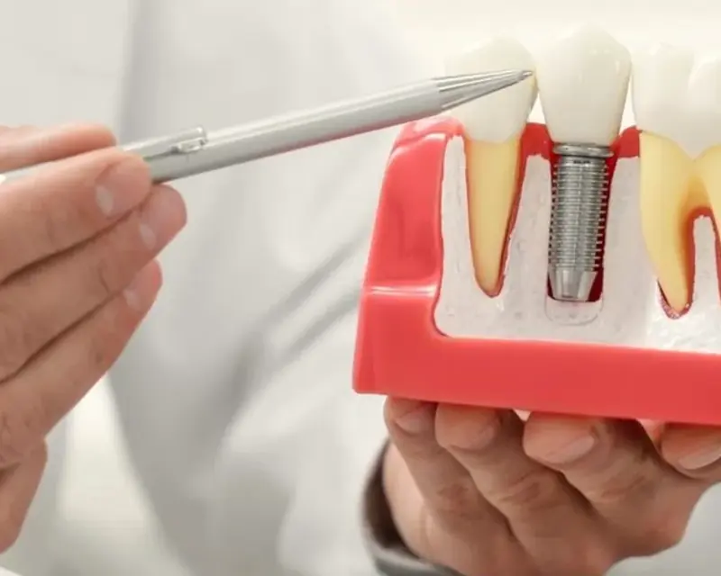 Modelo de implante dentário segurado pela dentista, mostrando o pino e a coroa