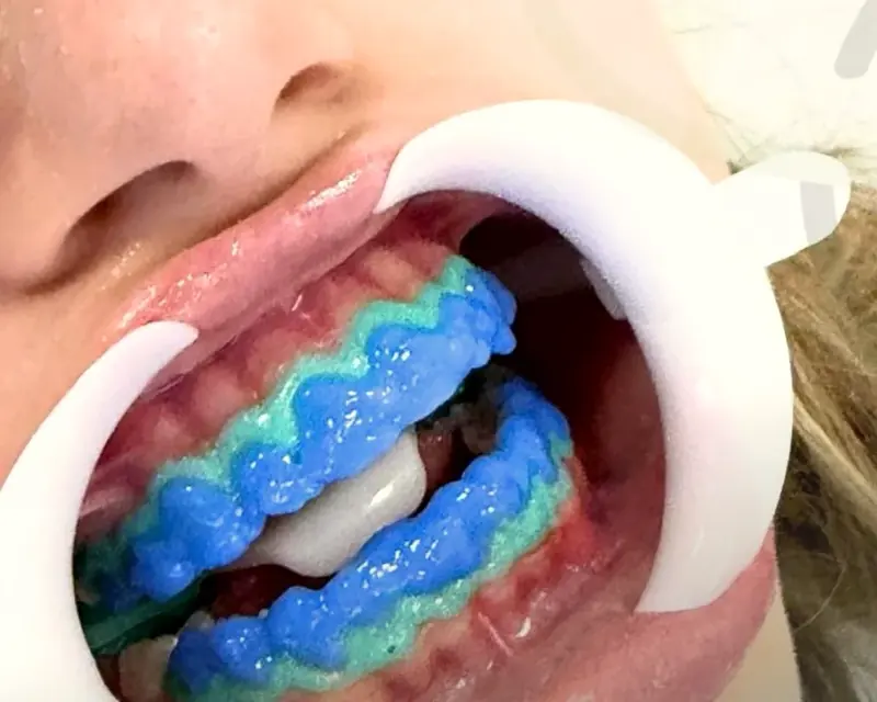 Clareamento de consultório com o gel aplicado nos dentes e afastador labial