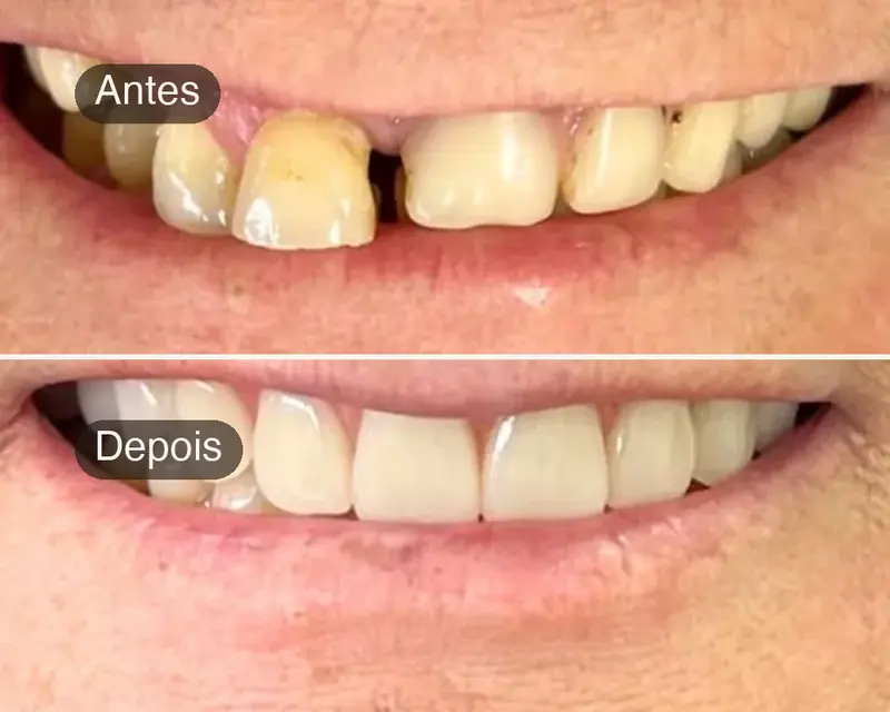 Antes e depois de reabilitação estética com prótese, fechando o espaço entre os dentes
